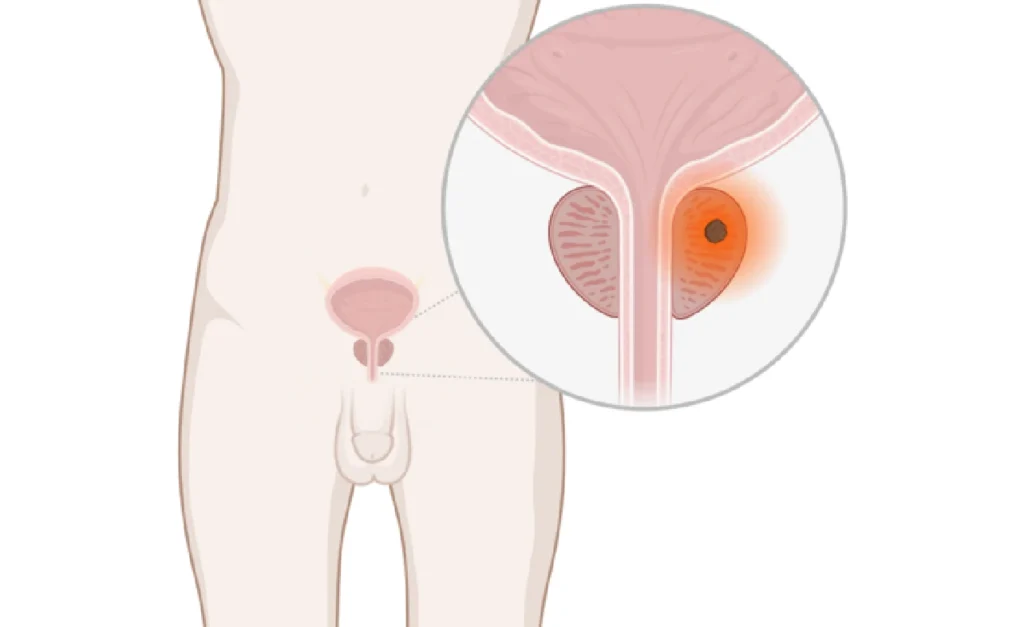 Anzeichen auf Prostatakrebs