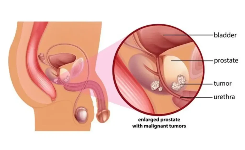 Behandlung von Prostatakrebs