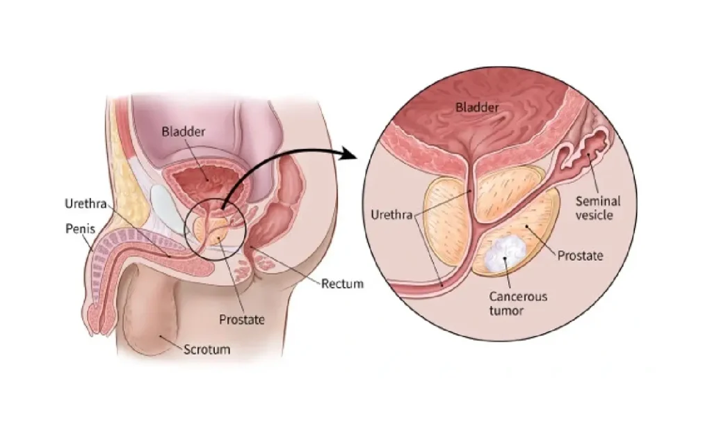Wie stirbt man an Prostatakrebs