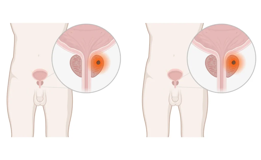 Darmprobleme nach Bestrahlung bei Prostatakrebs