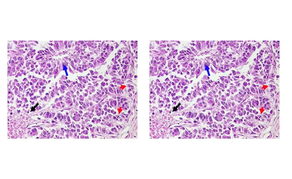 Großzelliges Neuroendokrines Karzinom