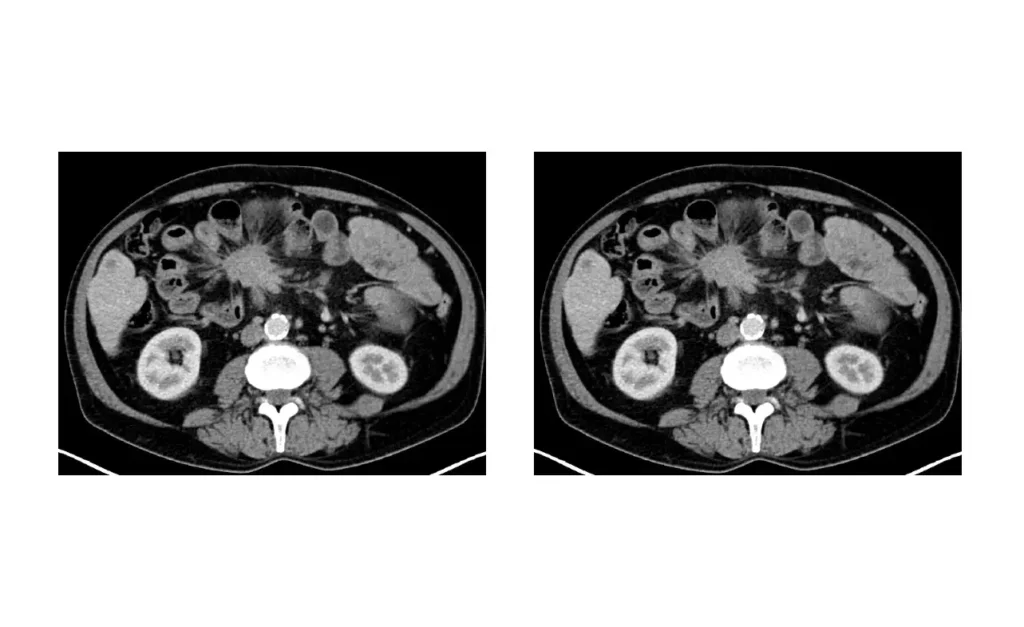 Kleinzelliges neuroendokrines Karzinom