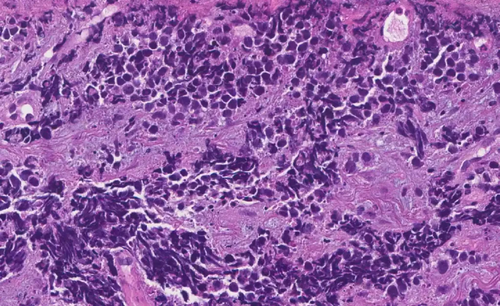 Neuroendokriner Tumor Endstadium