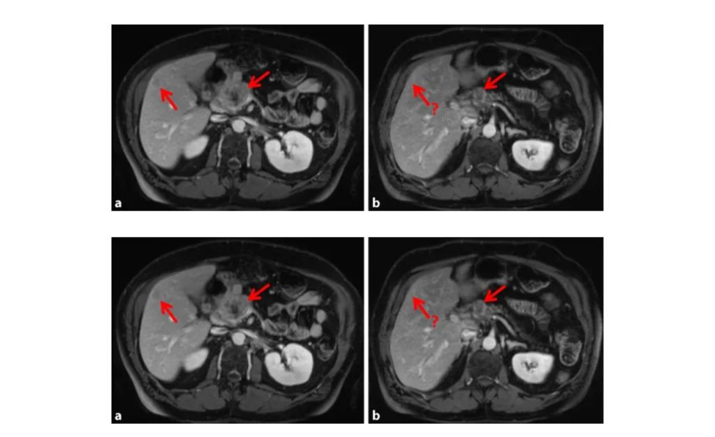 Neuroendokriner Tumor Palliativ