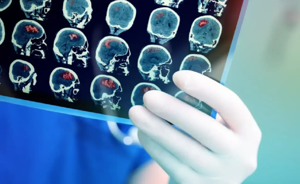 Neuroendokriner Tumor Stadium 4