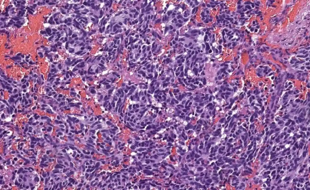 Neuroendokrines Karzinom