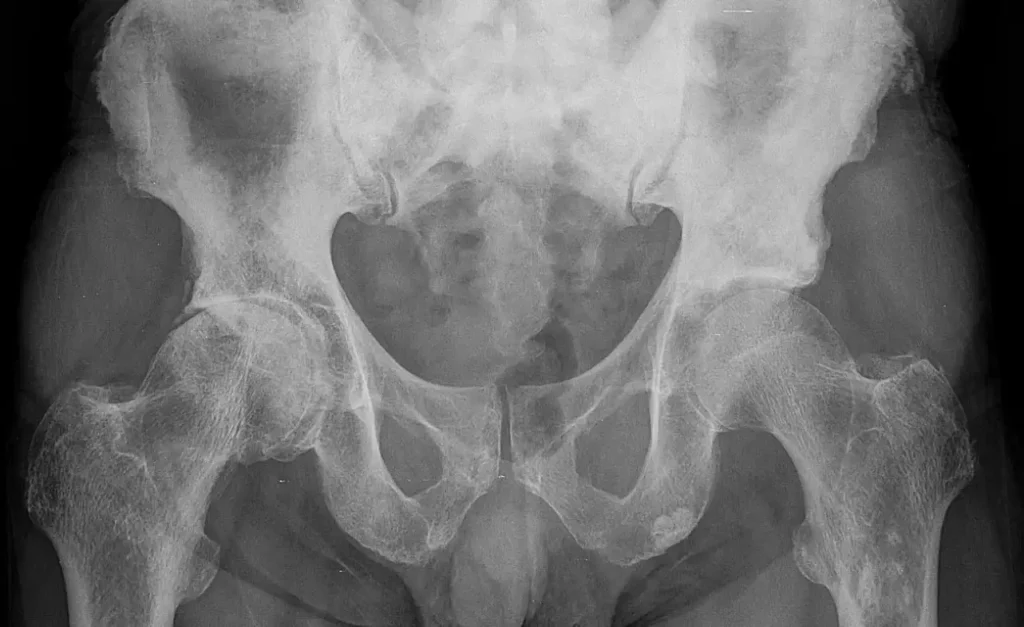 Prostatakrebs mit Metastasen