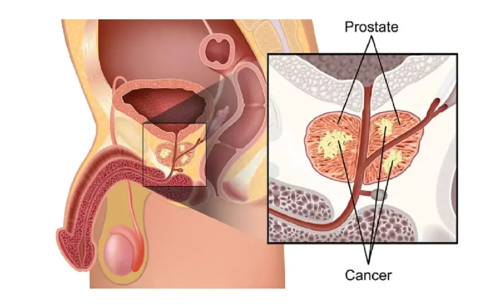 Wie hoch ist der PSA-Wert bei Prostatakrebs